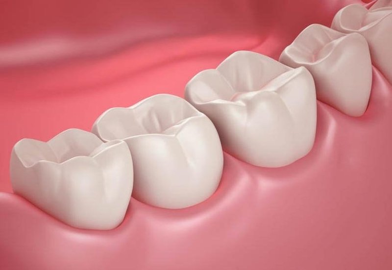 composite fillings