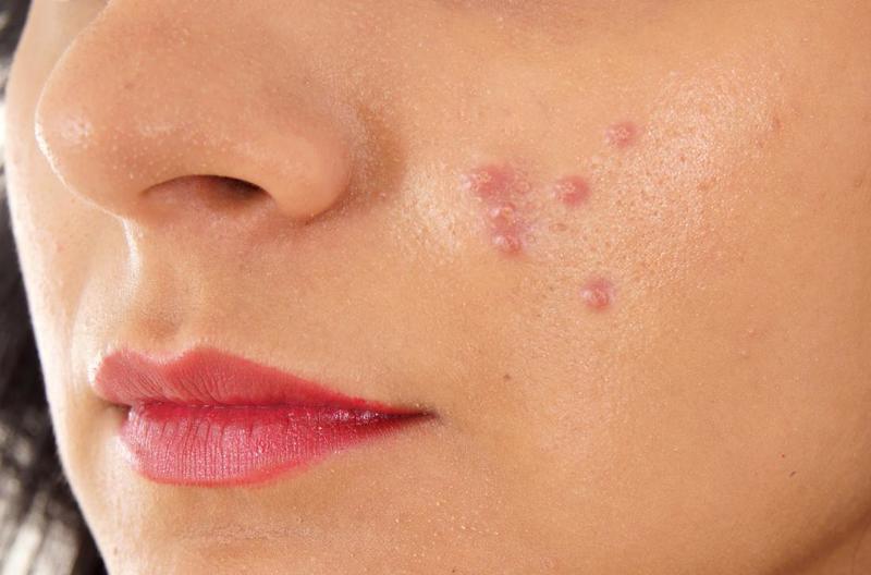 cold-sore-or-pimple-how-to-tell-what-the-bump-on-your-lip-really-is