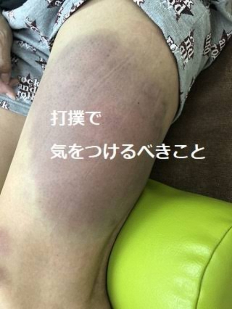 What Is The Difference Between あざ And 打ち身 あざ Vs 打ち身 Hinative